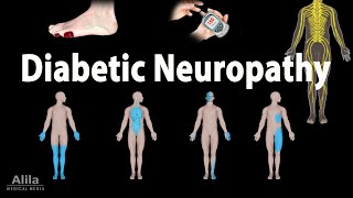 Diabetic Neuropathy Animation [upl. by Novak]