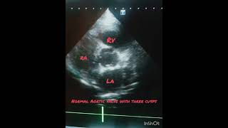 Short axis at Aortic valve level showing normal valve with 3 cusps [upl. by Cy]