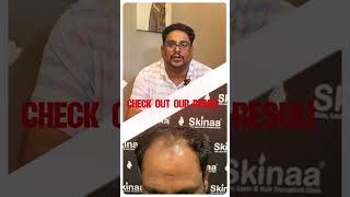 UNBELIEVABLE HAIR TRANSPLANT RESULT IN INDIA AT SKINAA CLINIC  BEFORE AND AFTER RESULTS shorts [upl. by Omrelliug]