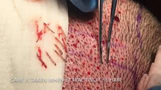 Follicular Unit Extraction FUE Hair Transplant by Dr Thomas Nakatsui [upl. by Lorain]