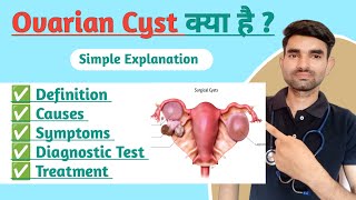 Ovarian Cyst in Hindi  Causes Symptoms And Treatment of Ovarian Cyst [upl. by Koblick]