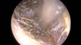 Ear Wax Removal in Narrow and Twisty Ear Canal  Mr Neel Raithatha The Hear Clinic [upl. by Peter]