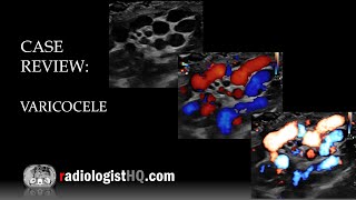 Ultrasound of Varicocele [upl. by Ravens191]