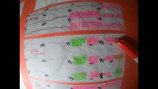 Eng3B ECG OF REPERFUSION INJURY STEMI W PCI [upl. by Corenda649]