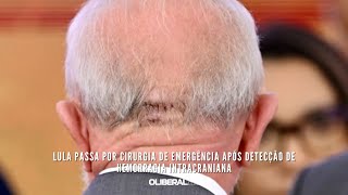 Lula passa por cirurgia de emergência após detecção de hemorragia intracraniana [upl. by Jolynn]