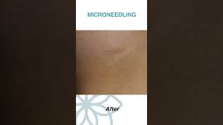 Microneedling with PRF for Scar Treatment  CARE Esthetics Before and After [upl. by Robinet]