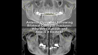 Anterior Open Bite Following Bilateral Condylar Fractures Why does it occur and how is it treated [upl. by Aiynot282]