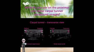 🔍 What do you see on the proximal and distal carpal tunnel ultrasound images Lets diagnose msk [upl. by Anifled]