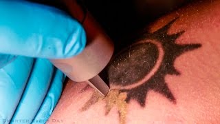 How Laser Tattoo Removal Works  Smarter Every Day 123 [upl. by Everick]