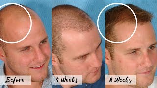 CURE FOR BALDNESS  Stop the Receding Hairline  Natural Hair Regrow Treatment [upl. by Kcaj]