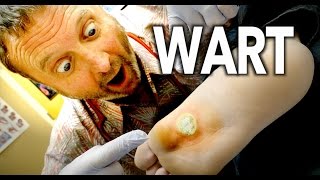 WORLDS LARGEST WART Frozen With Liquid Nitrogen  Dr Paul [upl. by Ateuqal10]