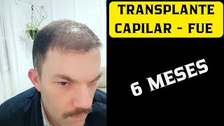 TRANSPLANTE CAPILAR  FUE 6 MESES  ESTOU SATISFEITO COM O RESULTADO [upl. by Huskamp]