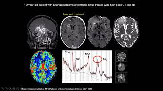 International Cancer Imaging Society Oct 17 Imaging of radiation induced CNS toxicity G Morana [upl. by Haym]