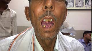 BULBAR PALSY PATIENT WITH TONGUE FASICULATIONS [upl. by Llehcor56]