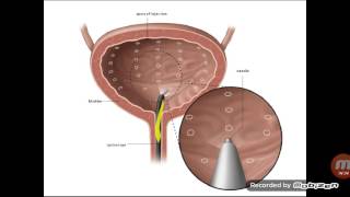 Transitional cell carcinoma [upl. by Hsirahc]