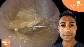 1064  Complete Ear Wax Blockage Removal [upl. by Prior]