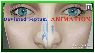 Rhinoplasty Animation  How can Breathing be improved by correcting a Deviated Septum [upl. by Nolyaj493]