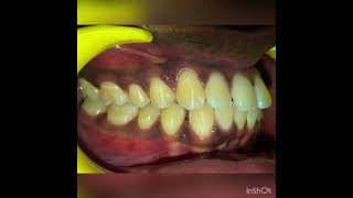 Orthodontic treatment using ceramic bracestrending orthodontist shorts [upl. by Teena]