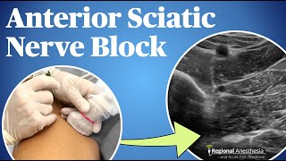 UltrasoundGuided Anterior Sciatic Nerve Block [upl. by Ailesor]