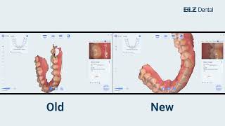 Scanning Performance of Intraoral Scanner New Software V2310002 Compared to Previous Version [upl. by Cantu]