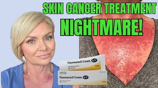 THE UGLY TRUTH ABOUT SKIN CANCER My Fluorouracil Treatment Journey [upl. by Mcleod]