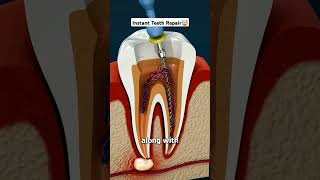 Damaged Tooth Repair Entire Process shorts viral [upl. by Yeffej324]