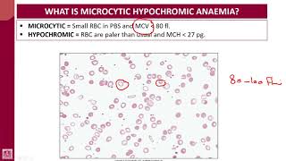 Hematology  1  U7L1  Introduction to microcytic hypochromic anaemias [upl. by Ostraw]