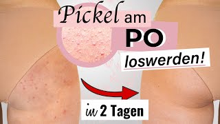 SCHNELL Pickel am Po loswerden 🍑 💯 [upl. by Bacchus195]