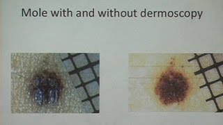 Melanoma and Nonmelanoma Skin Cancer [upl. by Iarised]