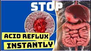 How to STOP ACID REFLUX Instantly [upl. by Cimbura]