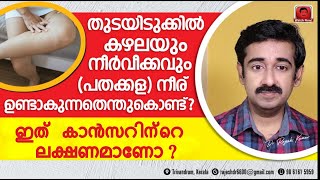 തുടയിടുക്കിൽ കഴലയും നീർവീക്കവും പതക്കള നീര് ഉണ്ടാകുന്നതെന്തുകൊണ്ട്  ഇത് കാൻസറിന്റെ ലക്ഷണമാണോ [upl. by Aneral]