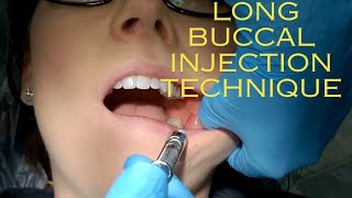 Long Buccal Injection Technique  local anaesthesia for long buccal nerve [upl. by Liuqa]