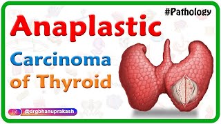 Anaplastic carcinoma of thyroid  Pathology USMLE Step 1 [upl. by Alodi299]