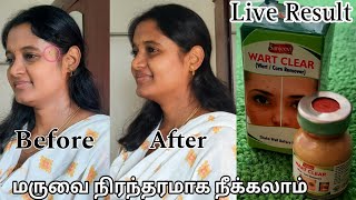 Wart Remover Honest Review in Tamil  வலியே இல்லாமல் மருவை நிரந்தரமாக நீக்கலாம்  Wart Remover Tamil [upl. by Norved]