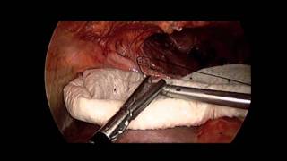 SS15 Best of Video V035 LAPAROSCOPIC REPAIR OF DIAPHRAGMATIC HERNIA AFTER CARDIAC TRANSPLANT [upl. by Assilla]