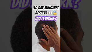 Minoxidil Before And After  Is 3 Months Enough  90 Day Results👀😥 [upl. by Martreb]