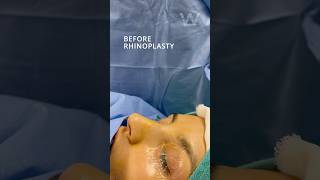 Before and immediately after Rhinoplasty nose job surgery results with Dr Wise in Wayne NJ [upl. by Ennalorac]