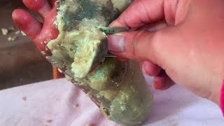 How to removal skin  callus removal skin flakes 39 [upl. by Urial153]