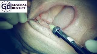 Infiltration anesthesia area 13 15 for implantation [upl. by Clite476]