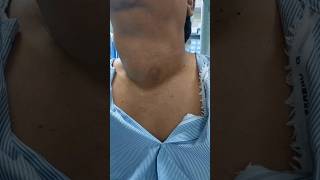 THYROID GOITER patient from TIRUPATI  kya hum unki thyroid SURGERY ko rok sake thyroidnodule [upl. by Cathe]