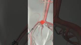 Learn How Cardiac Catheterization Works [upl. by Oalsecnew]