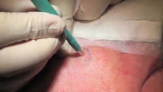 Punch Biopsy  Professor David Wilkinson  Professional Certificate of Skin Cancer Medicine [upl. by Leumhs109]