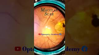 Macular Pathology Macular scar  Smartphone Fundus Videography  Short Video 66 viraloptometrist [upl. by Kral313]