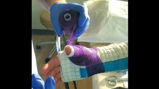 How to Make a Waterproof Thumb Spica Cast [upl. by Seuqirdor]