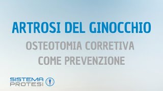 🔴 PROTESI del GINOCCHIO ▷▷ Osteotomia correttiva per prevenire lartrosi al ginocchio [upl. by Warchaw]