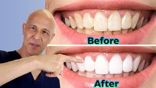 Whiten Your Teeth at Home the DIY Way  Dr Mandell [upl. by Diena]