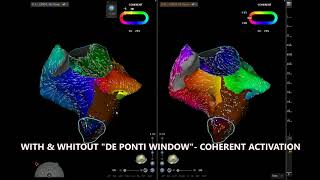 REDO OF RIGHT ATRIAL FLUTTER ABLATION  DECANAV amp V7 PRIME WORKFLOW [upl. by Thor]