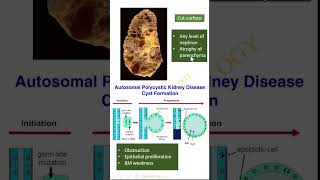 Lesions in Pathology Polycystic kidney Dr GSS SRM MCH RC httpsyoutubeBPdgqu1FE [upl. by Budde]