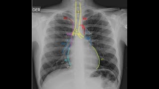 Radiografía de Tórax Anatomía y la importancia del análisis sistemático [upl. by Nylanaj372]