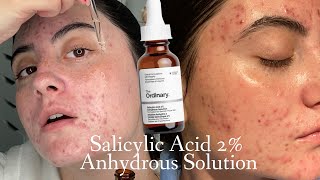 TESTING THE ORDINARY SALICYLIC ACID 2 ANYDROUS SOLUTION FOR 3 WEEKS ON HORMONAL ACNE SKIN [upl. by Saint]